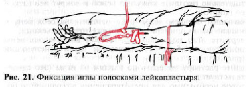 Технологія виконання внутрішньовенних крапельних вливань: заповнення системи. Внутрішньовенне крапельне введення розчинів техніка збору системи для внутрішньовенного крапельного введення